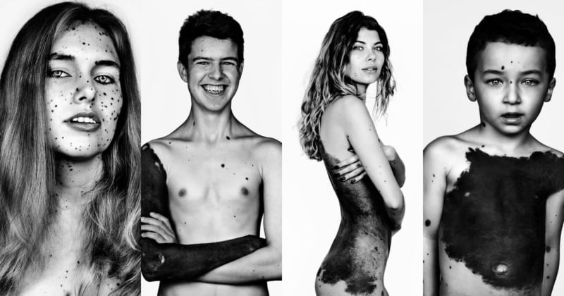  portraits people ultra-rare type body-covering birthmark 