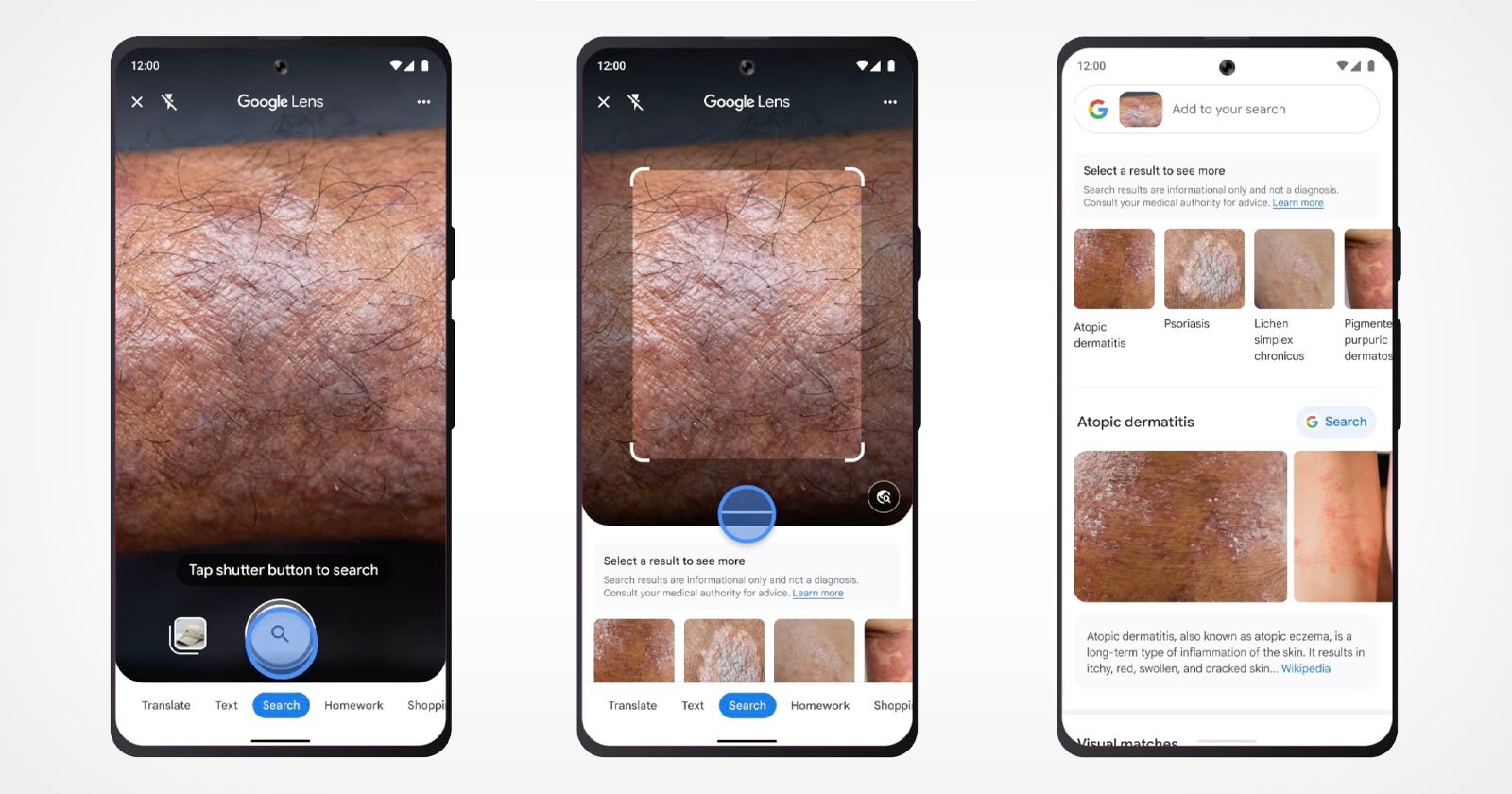  google lens can now search skin conditions 