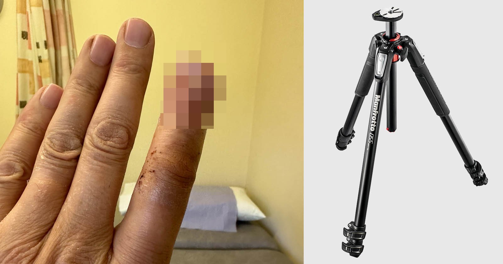  photographer loses part finger after tripod snaps shut 