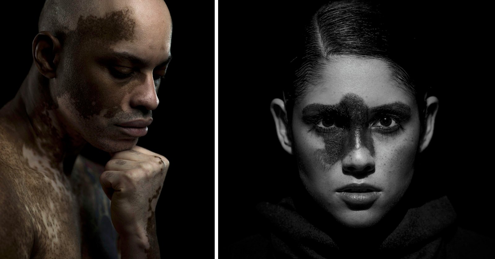  unusual beauty photo series celebrates rare skin conditions 