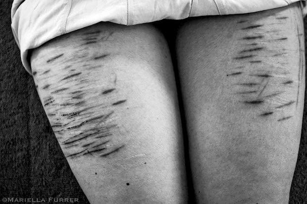 The mutilated legs of Susanna, a 24yr old girl, who has Disocciative Identity Disorder (DID), previously known as Multiple Personality Disorder. Having endured severe ritual abuse for almost 18 years, Susanna developed DID as a coping mechanism and has in excess of 300 different identities who all struggle with the abuse inflicted on them, and most of them including Susanna are self-mutilators. I have personally spoken to over 50 different identities. Each with horrific stories of abuse.