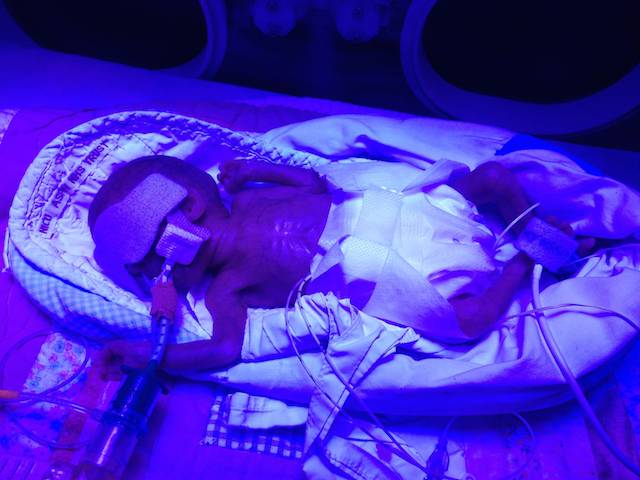Day 3: Phototherapy to help reduce jaundice and develop her skin.