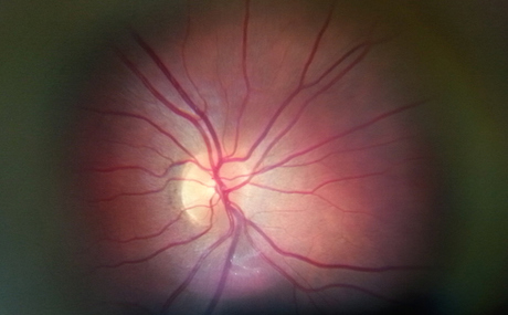 An image of the inside of the eye taken with Peek Retina