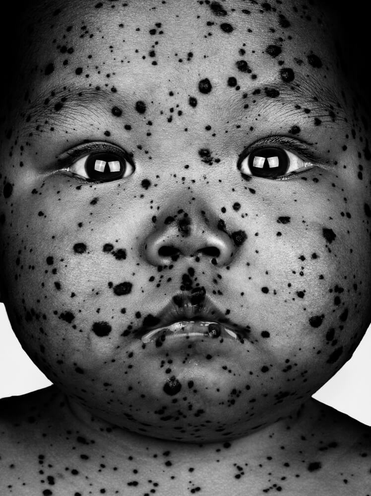 Portraits of People with an Ultra-Rare Type of Body-Covering Birthmark ...