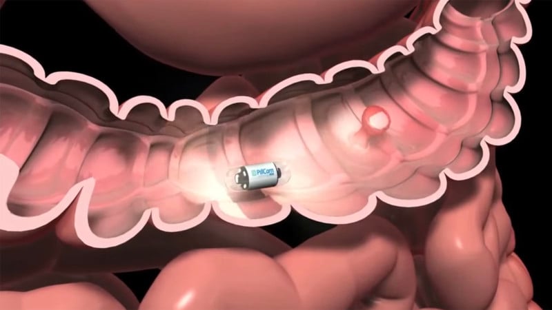 colonoscopy camera pill