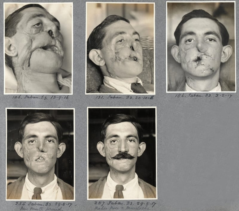 Photos Showcase Pioneering Plastic Surgeon's Work on WW1 Soldiers