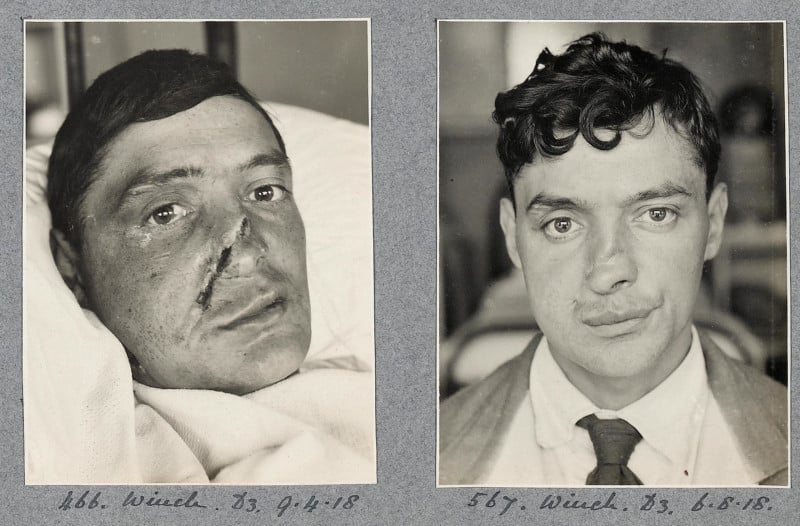 Early Plastic Surgery Pictures