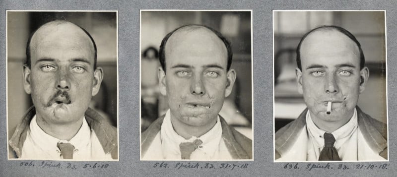 Photos Showcase Pioneering Plastic Surgeon's Work on WW1 Soldiers ...