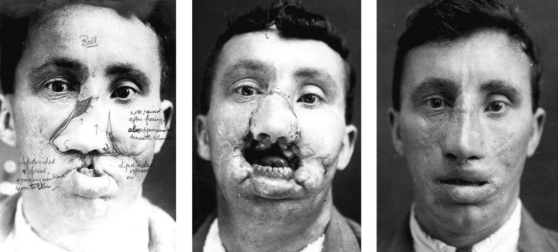 The Facemaker: A Surgeon's Battle to Mend Disfigured WW1 Soliders 