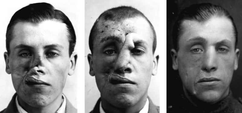 The Facemaker: A Surgeon's Battle to Mend Disfigured WW1 Soliders 