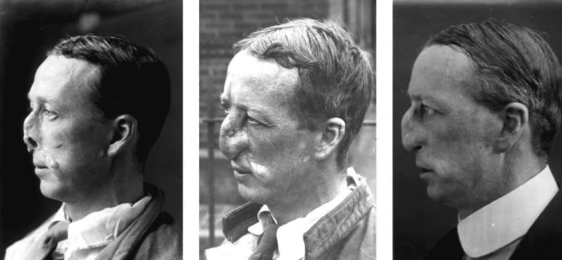 The Facemaker: A Surgeon's Battle to Mend Disfigured WW1 Soliders 