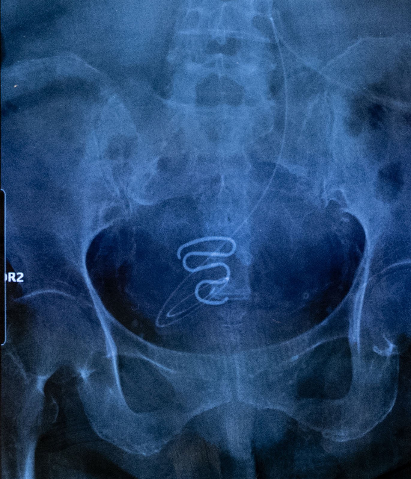 X-ray image showing a pelvic area with a visible intrauterine device (iud) in position.