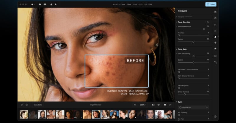 A close-up image of a person using a photo editing software with the retouch panel open. The screen shows a "Before" box highlighting the person's cheek with acne blemishes. Editing options such as blemish removal and skin smoothing are visible on the right.