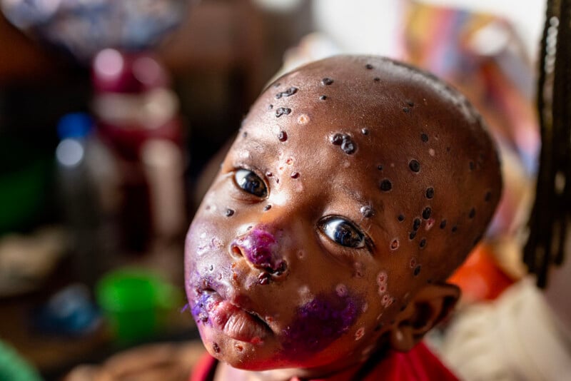 A close-up of a child with numerous lesions on the face, including purple marks around the lips and nose, looking directly at the camera. The background is blurred with various out-of-focus objects.