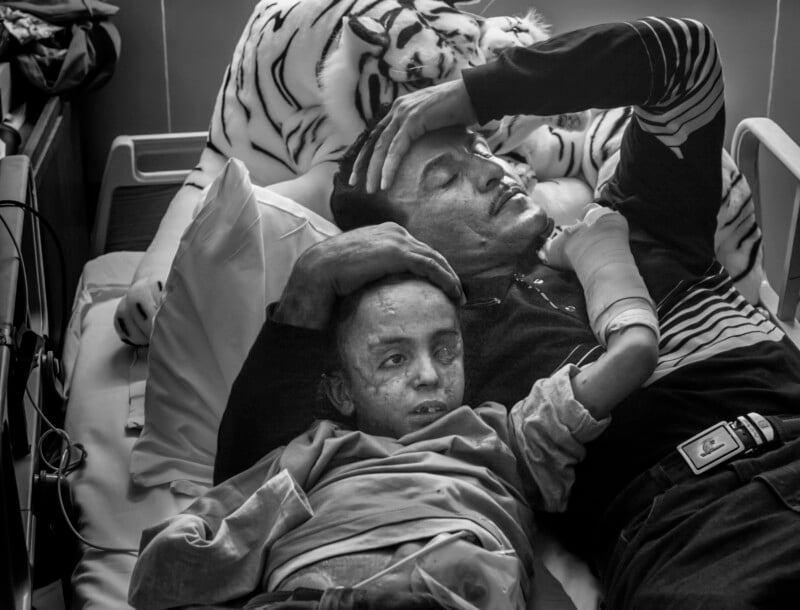 A black and white image shows a man lying in a hospital bed with a young boy resting against him. The boy has a wrapped arm and visible marks on his skin. A stuffed tiger toy is placed beside them.