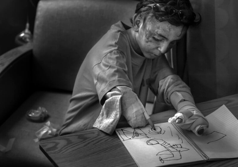 A black and white image of a person with bandaged hands drawing in a notebook with a pen. They are sitting at a table, deeply focused on their art, with various drawing tools and papers scattered around.