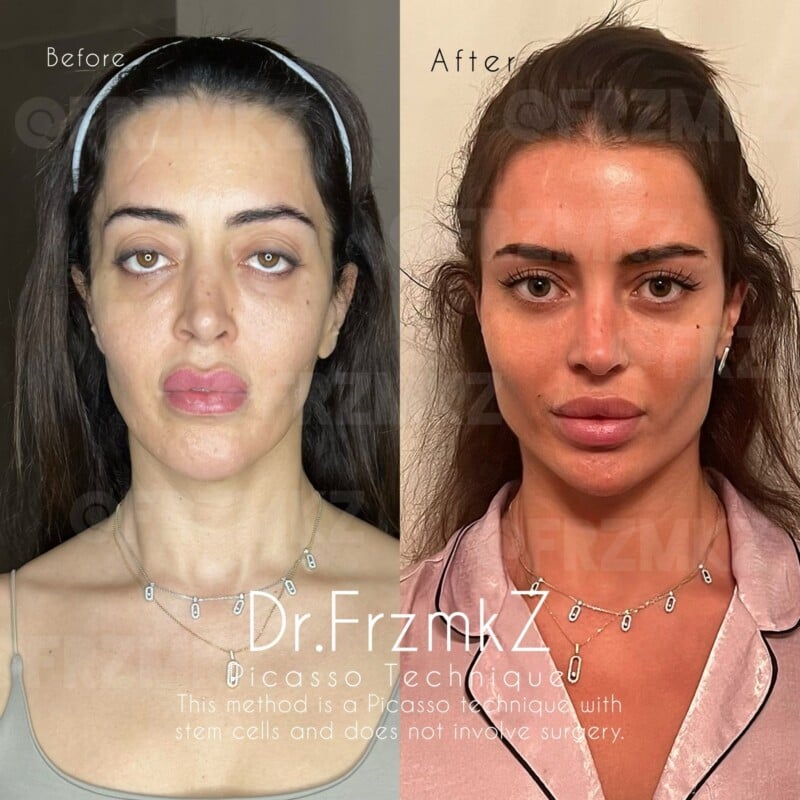 Split-image showing a "Before" and "After" of a woman post-cosmetic procedure. The left side shows her with tired eyes and uneven skin tone; the right side shows smoother skin, brighter eyes, and fuller lips. Text overlays describe the procedure.