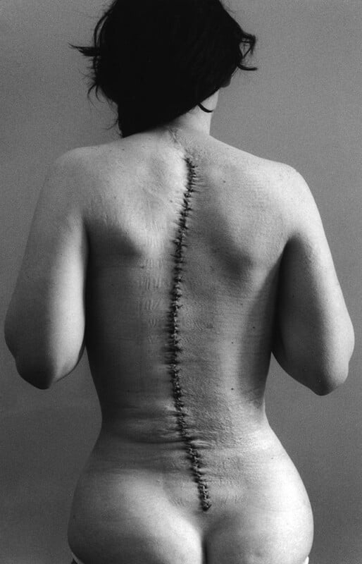 Back view of a person with a long surgical scar running down the spine, with visible stitches. The person has medium-length dark hair and is shown from the waist up. The image is in black and white and shows the texture of the skin and scar.