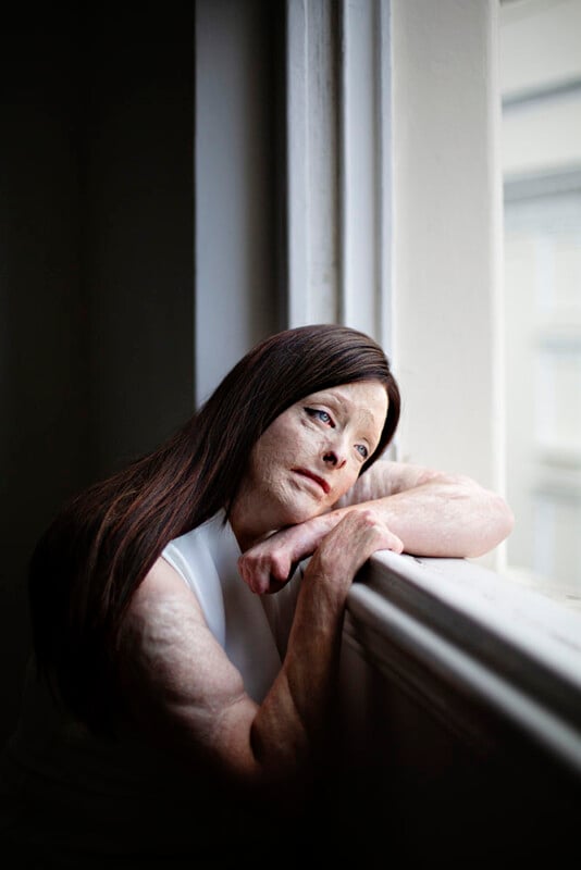 A woman with long brown hair and visible burn scars on her face and arms leans on a windowsill, gazing thoughtfully outside with her head resting on her arm. Soft natural light comes through the window.