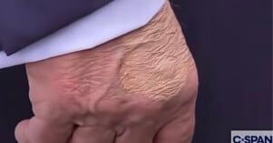 Close-up of a person's hand with a large, light-colored patch of dry, rough skin on the back, showing noticeable texture and wrinkles. Part of a sleeve and the C-SPAN logo are visible in the corner.
