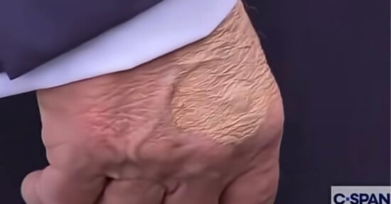 Close-up of a person's hand with a large, light-colored patch of dry, rough skin on the back, showing noticeable texture and wrinkles. Part of a sleeve and the C-SPAN logo are visible in the corner.