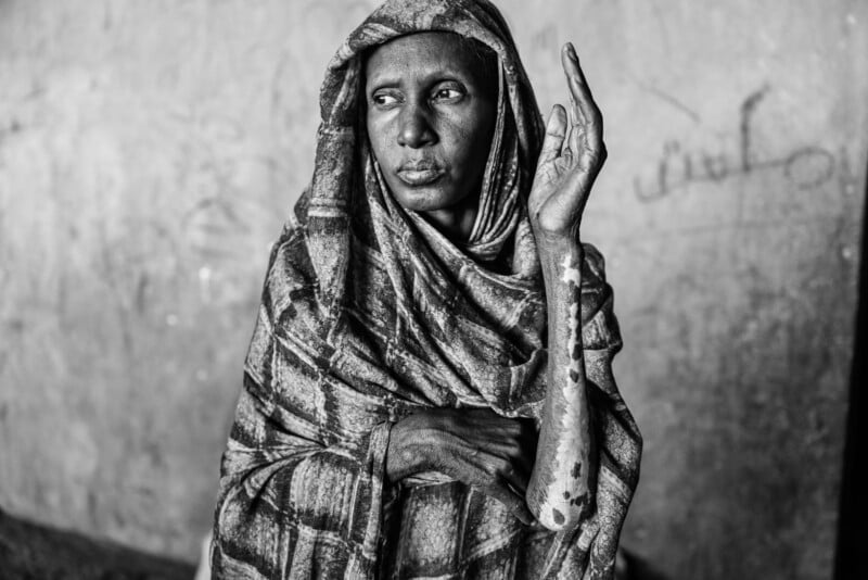 Black and white photo of a woman in a patterned headscarf, looking to the side. She raises one hand, revealing visible patches of discoloration on her arm. The background is blurred, showing a textured wall.