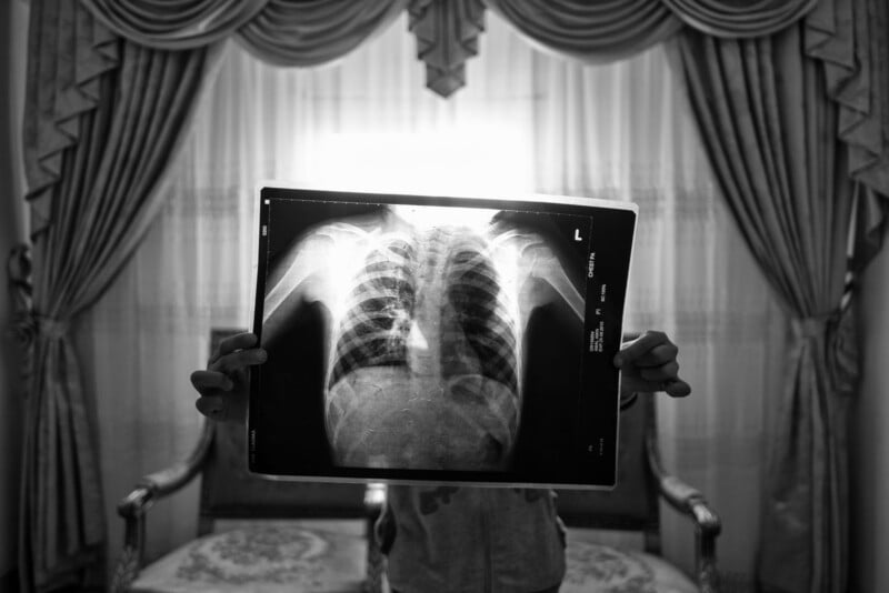 A person holds up a chest X-ray in front of themselves, aligning it with their body, in a room with ornate curtains and a patterned chair in the background, all in black and white.