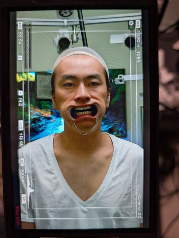 A person wearing a white shirt and headband faces the camera with a dental mouth opener in place, visible through a camera screen interface with focus marks and settings.
