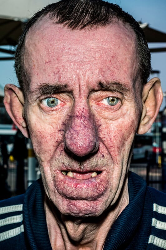A close-up portrait of an older man with a ruddy complexion, prominent facial veins, and a bulbous nose.