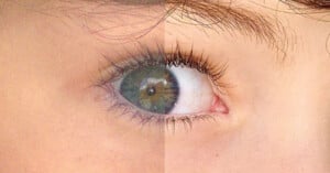 A split-screen comparison showing a grainy, low-resolution eye on the left and a clear, high-resolution eye on the right.