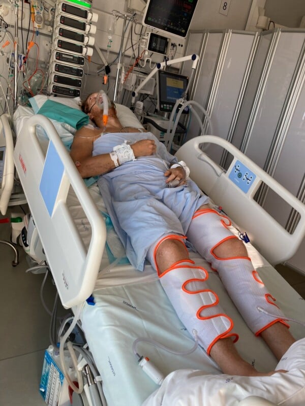 A patient lies in a hospital bed connected to a ventilator and multiple monitors, wearing sequential compression devices on their legs.